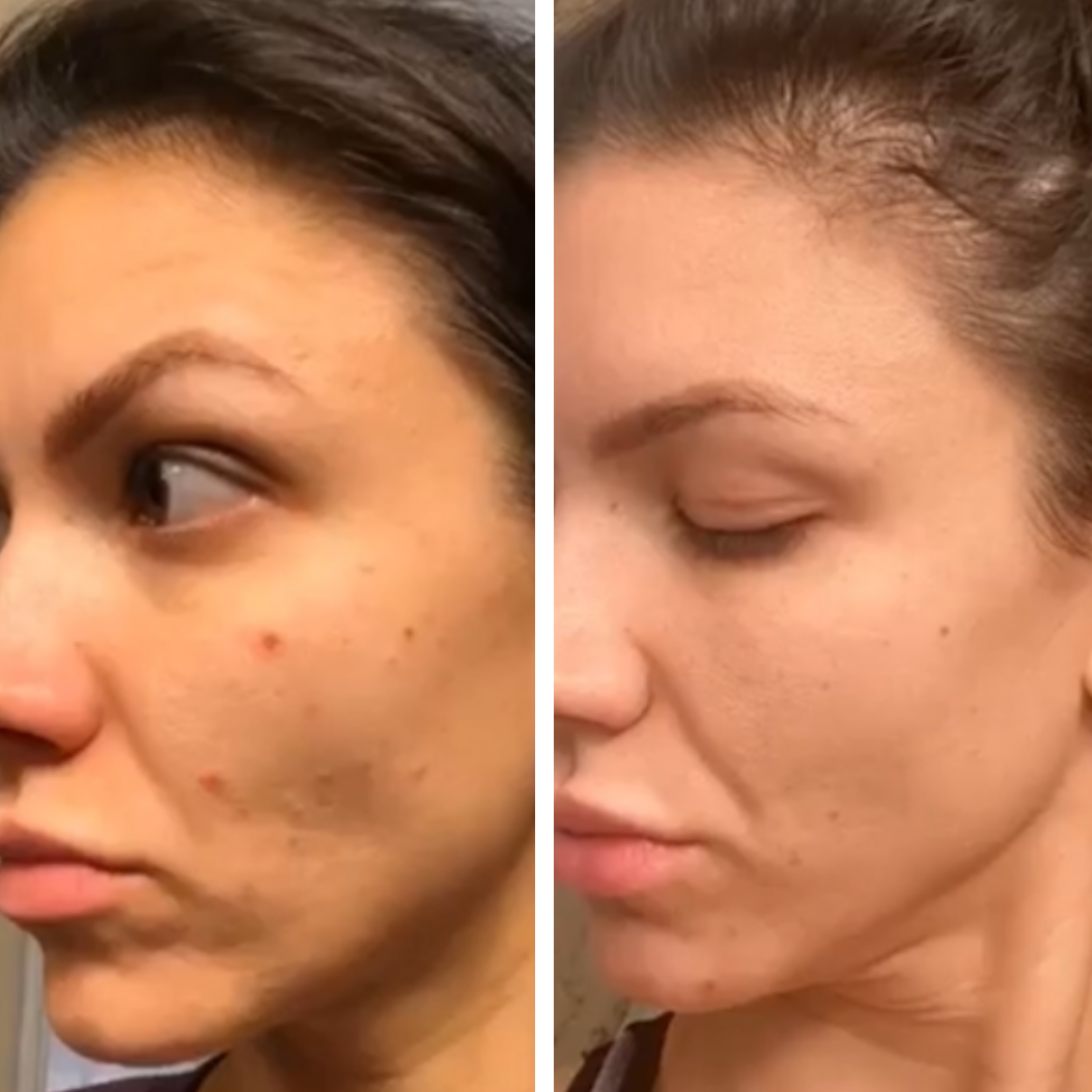Before and after comparison of a woman's face with acne on the left and clear skin on the right.