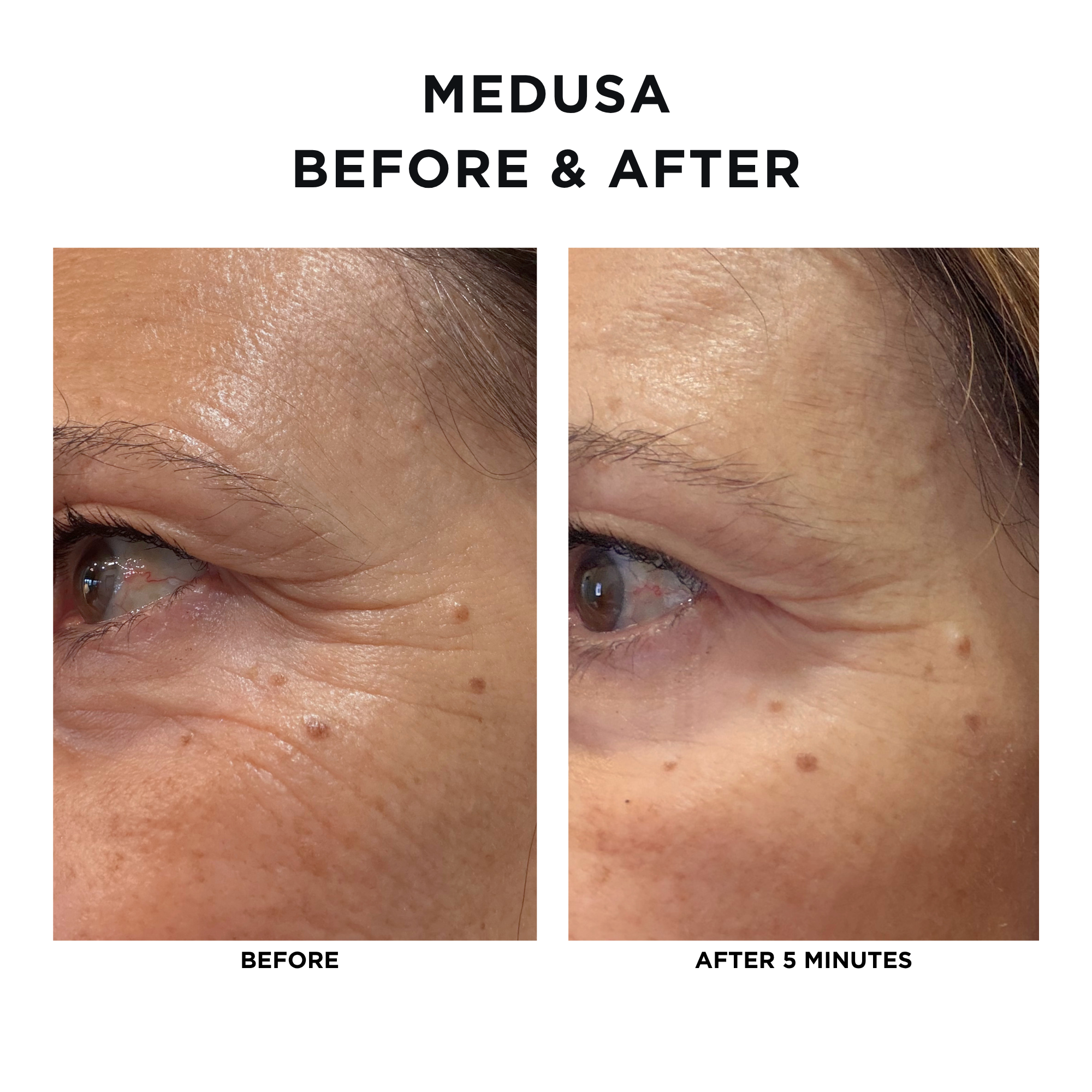 Medusa Tightening Treatment