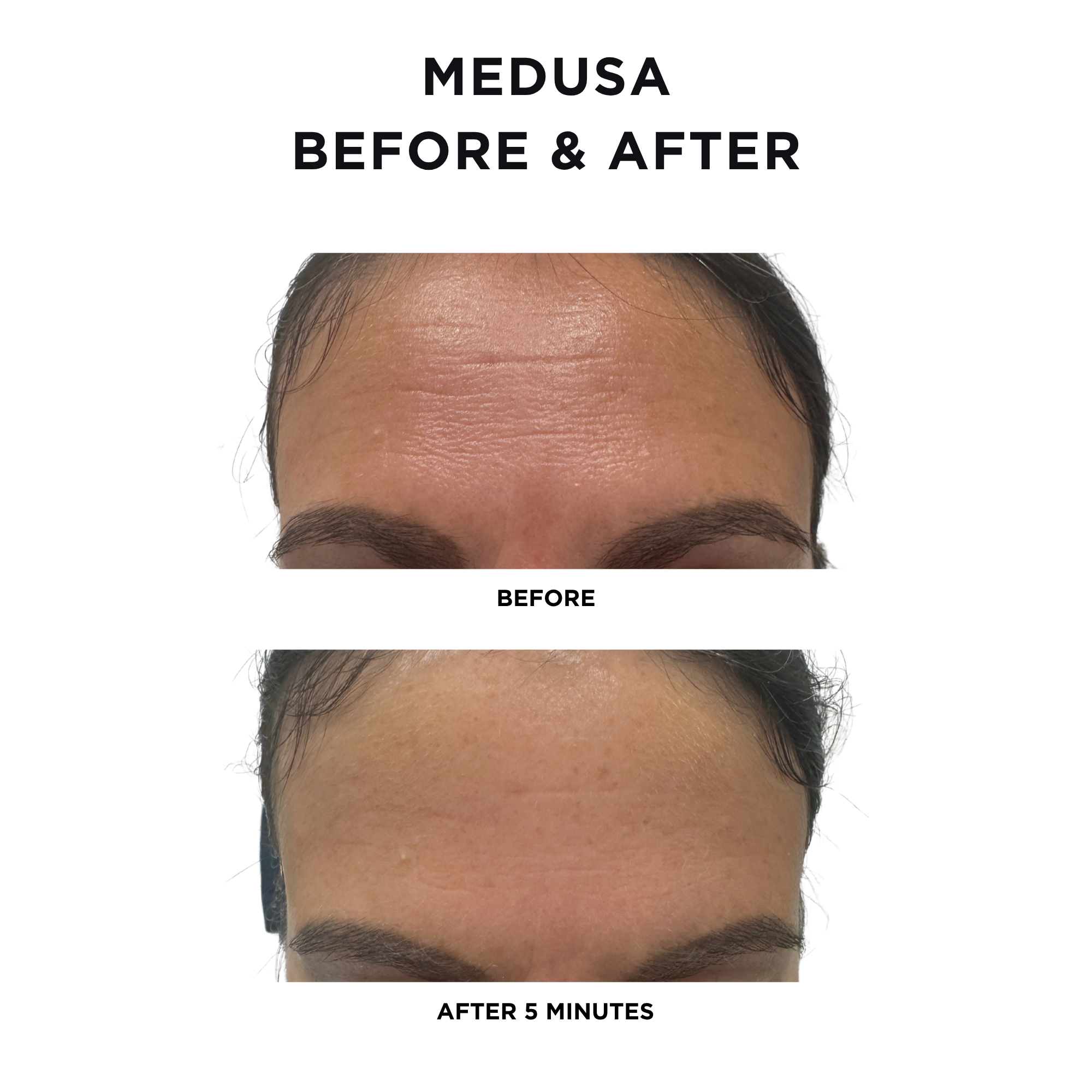Medusa Tightening Treatment