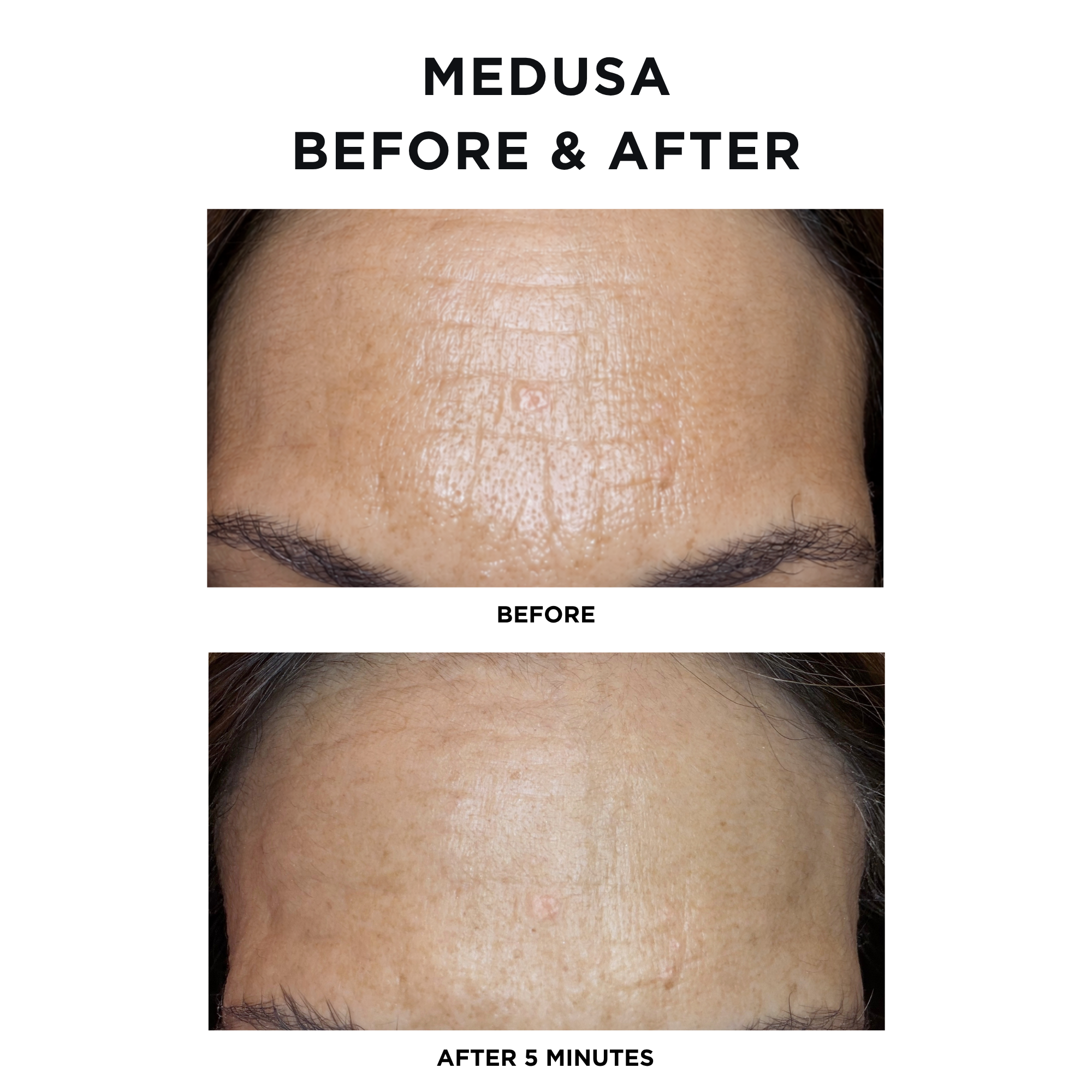 Medusa Tightening Treatment