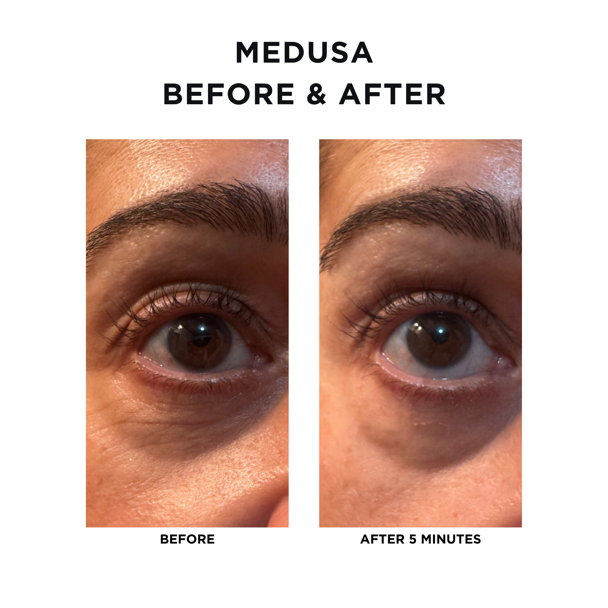 Medusa Tightening Treatment