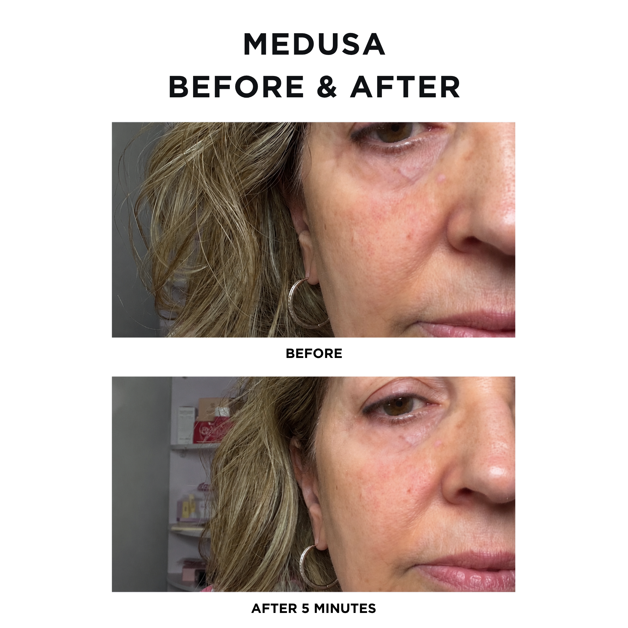 Medusa Tightening Treatment