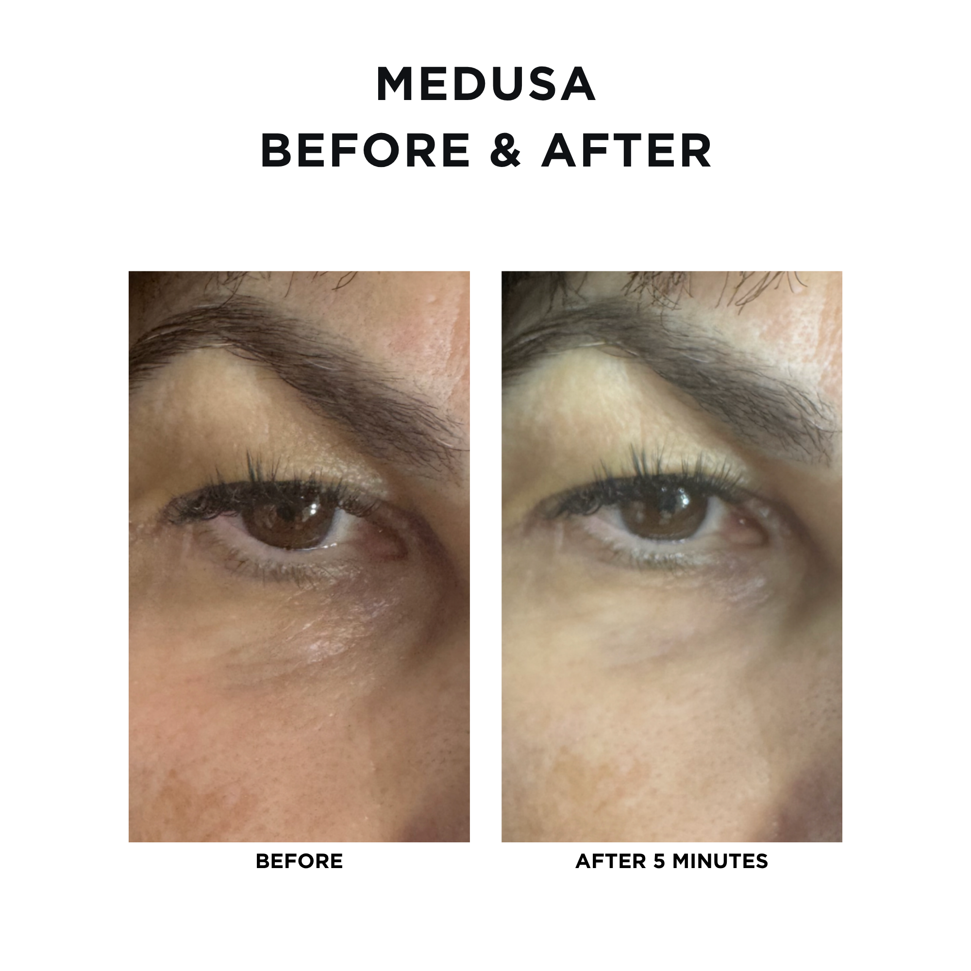 Medusa Tightening Treatment