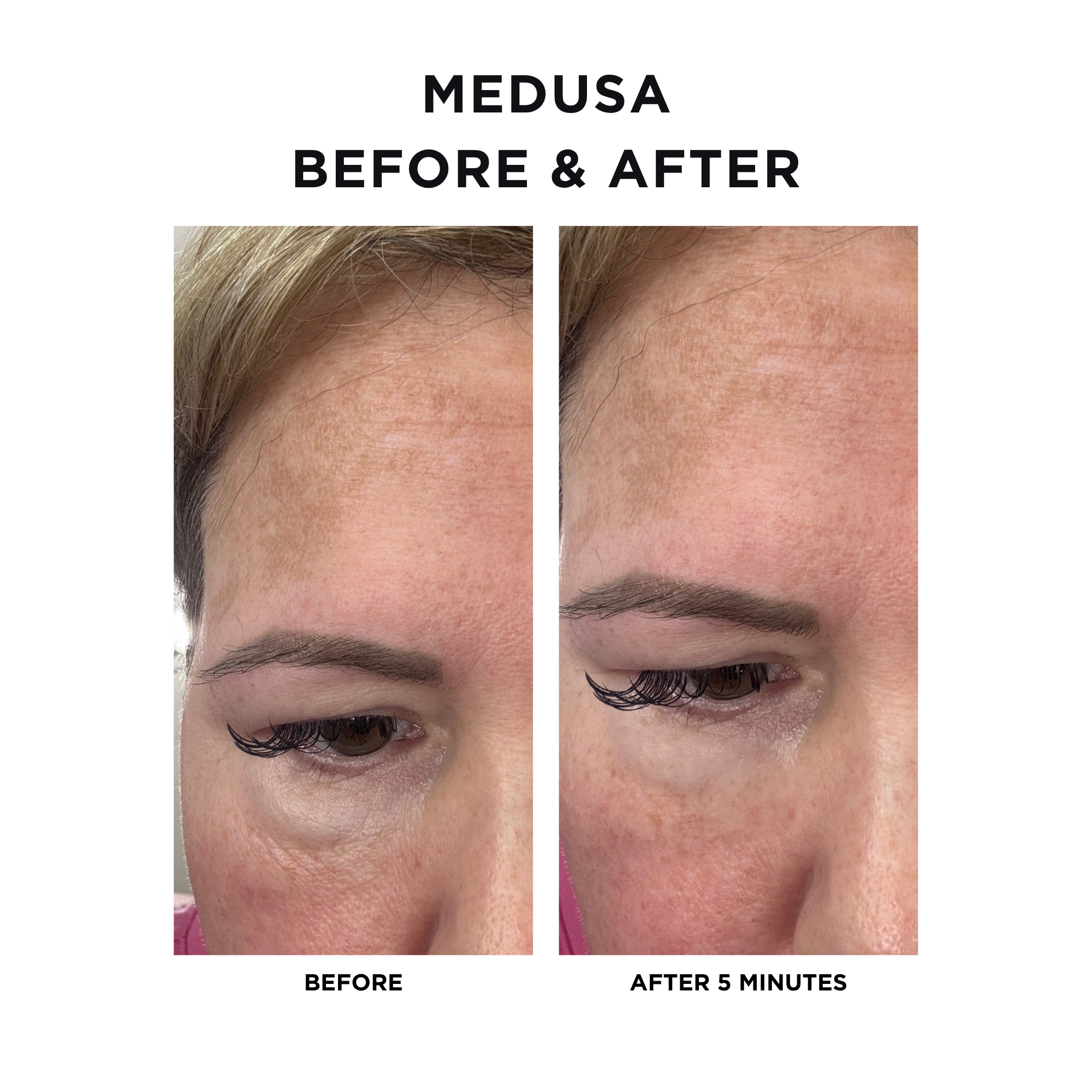 Medusa Tightening Treatment